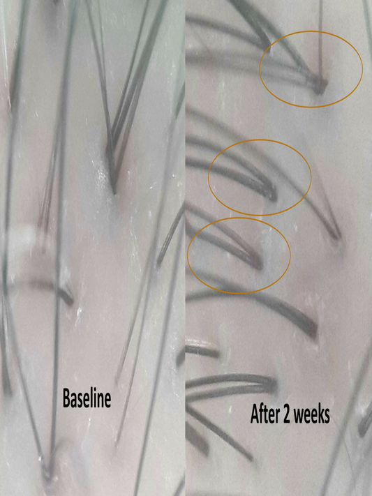 RHX APEX™ Advanced Follicle Activator - for a luxury skin aesthetic clinic