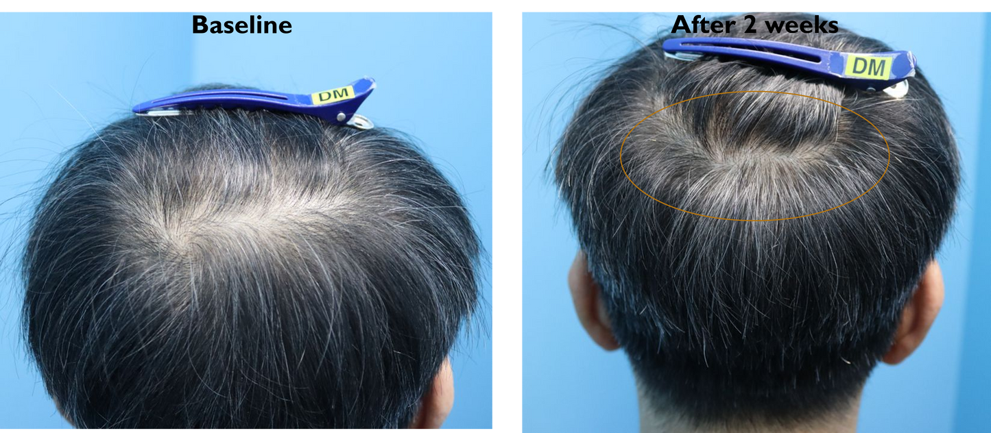 RHX APEX™ Advanced Follicle Activator - for a luxury skin aesthetic clinic