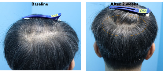 RHX APEX™ Advanced Follicle Activator