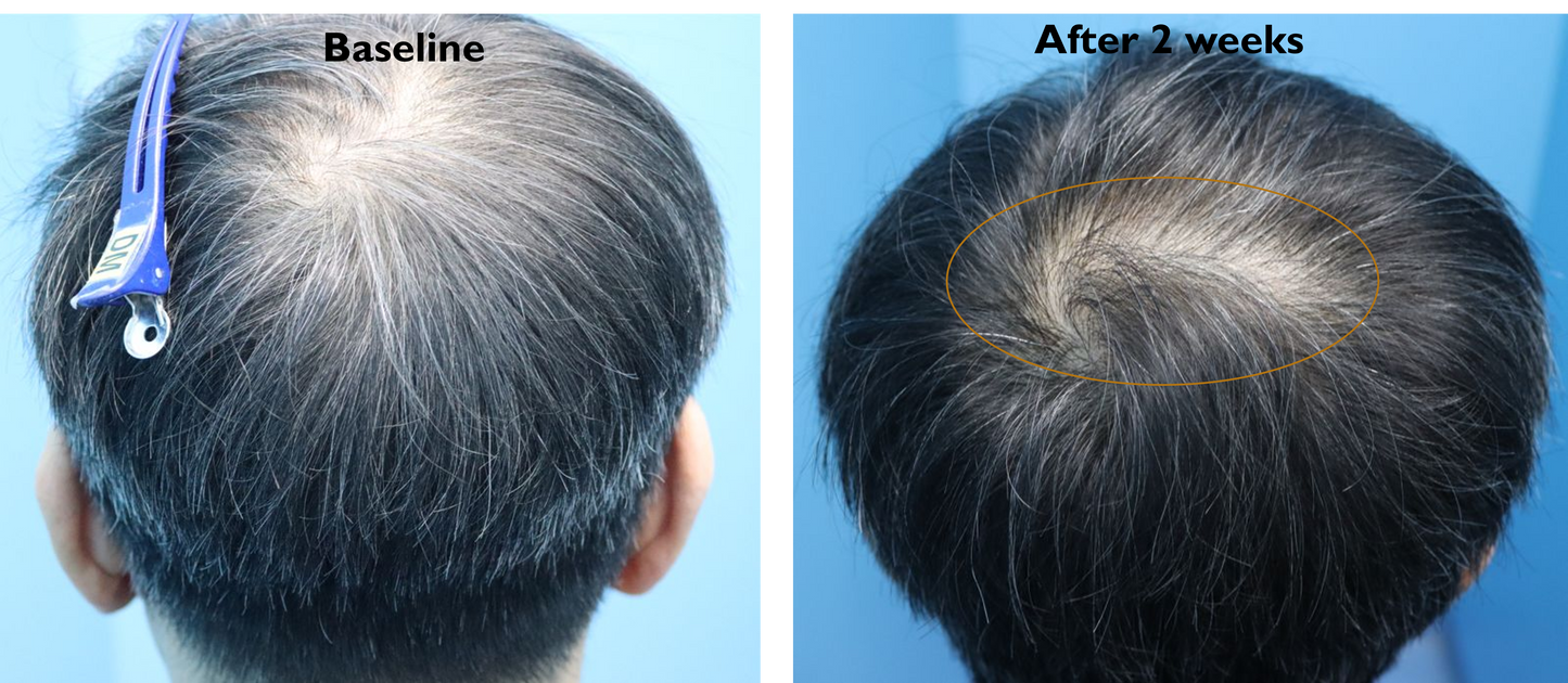 RHX APEX™ Advanced Follicle Activator