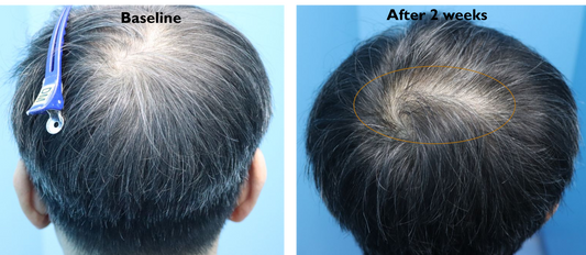 RHX APEX™ Advanced Follicle Activator