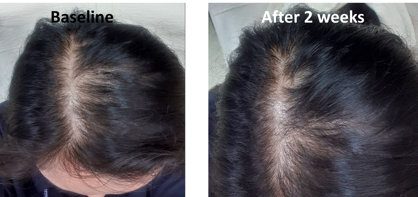 LIORA VERTEX™ Advanced Follicle Activator