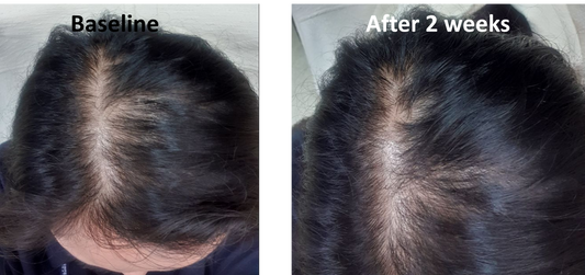 LIORA VERTEX™ Advanced Follicle Activator